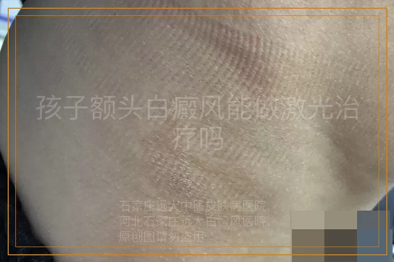 孩子额头白癜风能做激光治疗吗