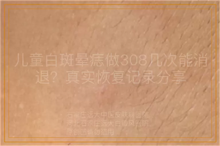 儿童白斑晕痣做308几次能消退？真实恢复记录分享