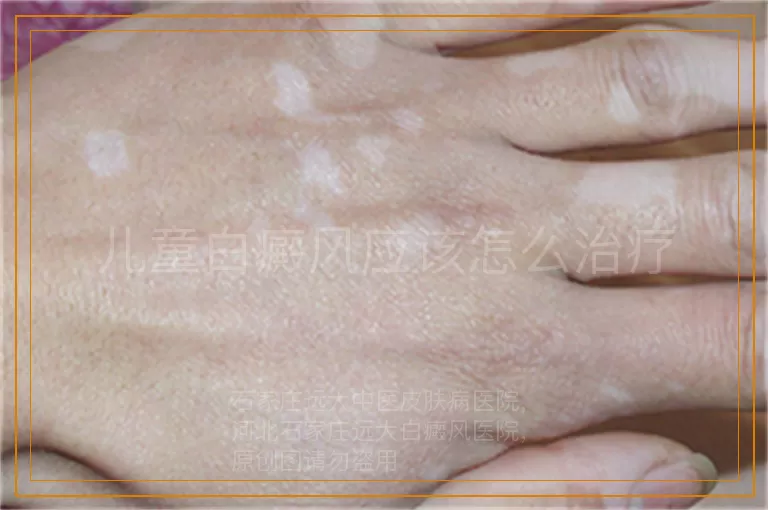 儿童白癜风应该怎么治疗