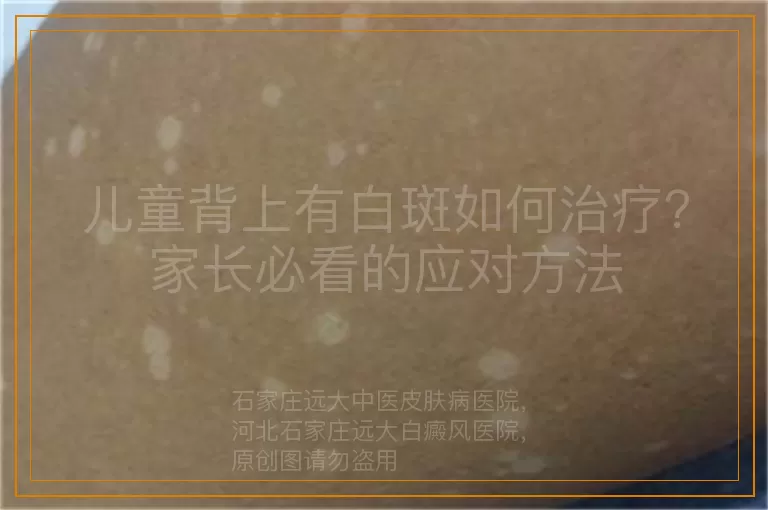 儿童背上有白斑如何治疗？家长必看的应对方法