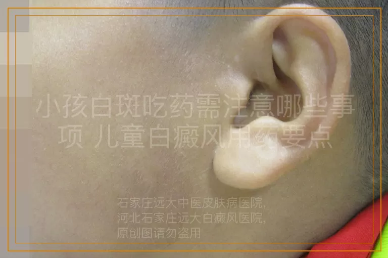 小孩白斑吃药需注意哪些事项 儿童白癜风用药要点
