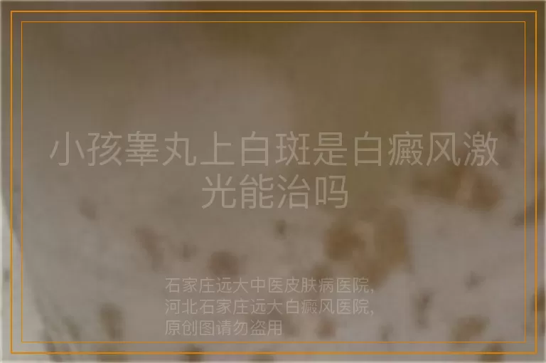 小孩睾丸上白斑是白癜风激光能治吗