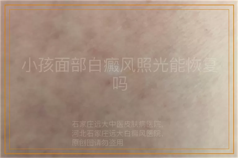 小孩面部白癜风照光能恢复吗