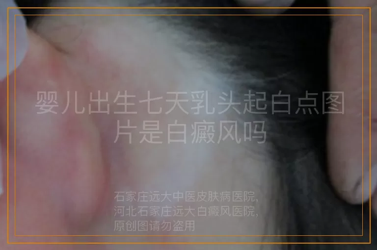 婴儿出生七天乳头起白点图片是白癜风吗