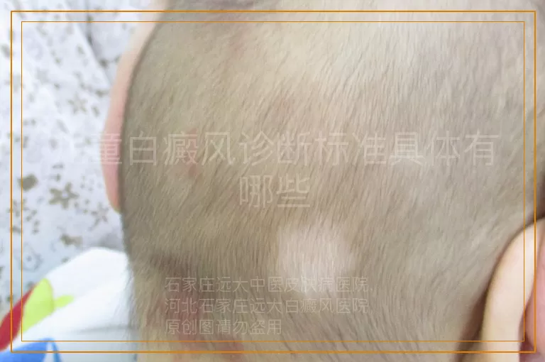 儿童白癜风诊断标准具体有哪些
