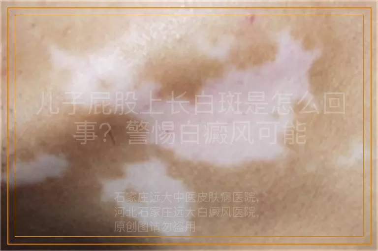 儿子屁股上长白斑是怎么回事？警惕白癜风可能
