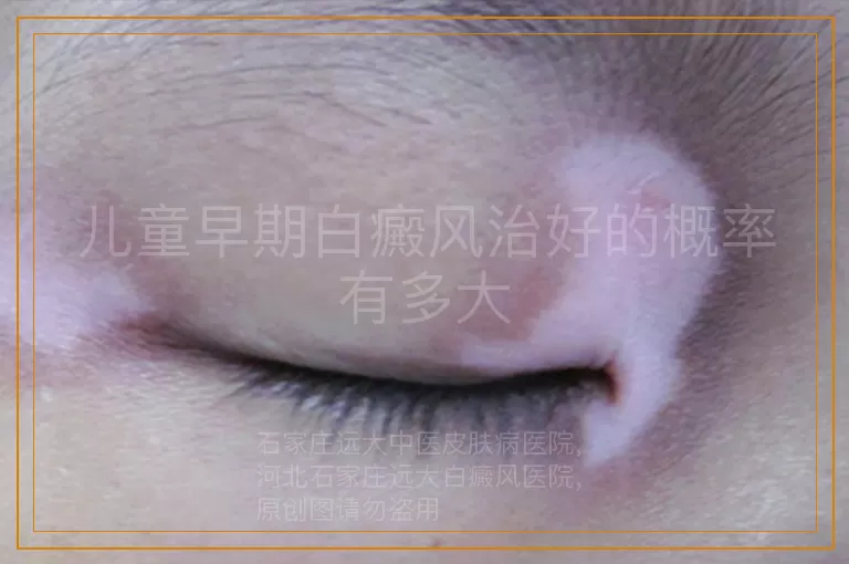 儿童早期白癜风治好的概率有多大
