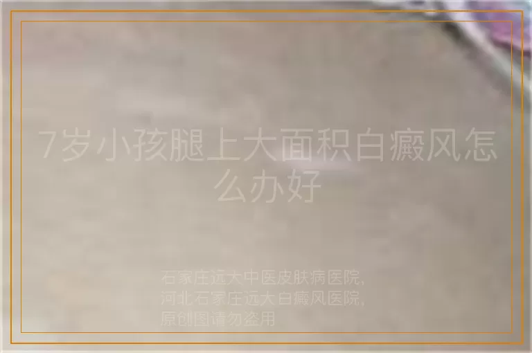7岁小孩腿上大面积白癜风怎么办好