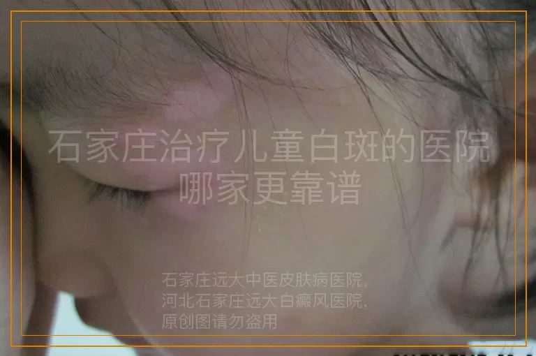 石家庄治疗儿童白斑的医院哪家更靠谱