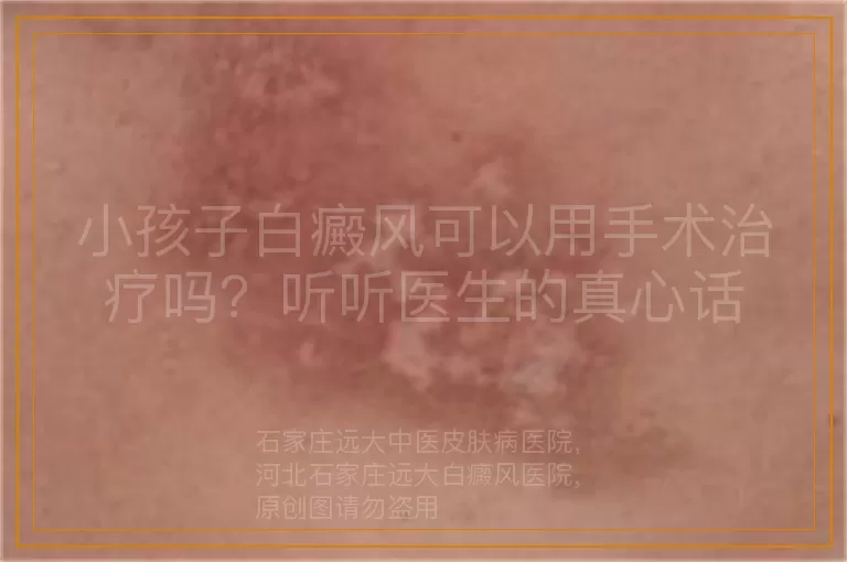 小孩子白癜风可以用手术治疗吗？听听医生的真心话
