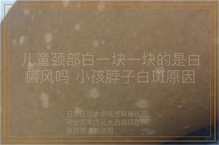 儿童颈部白一块一块的是白癜风吗 小孩脖子白斑原因