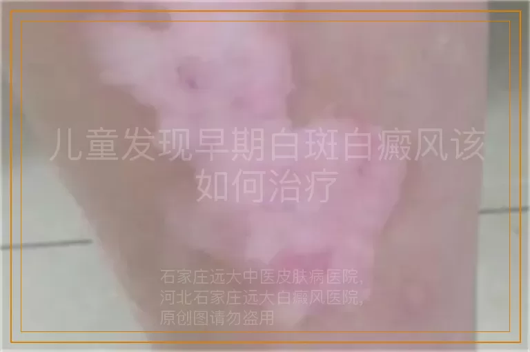 儿童发现早期白斑白癜风该如何治疗
