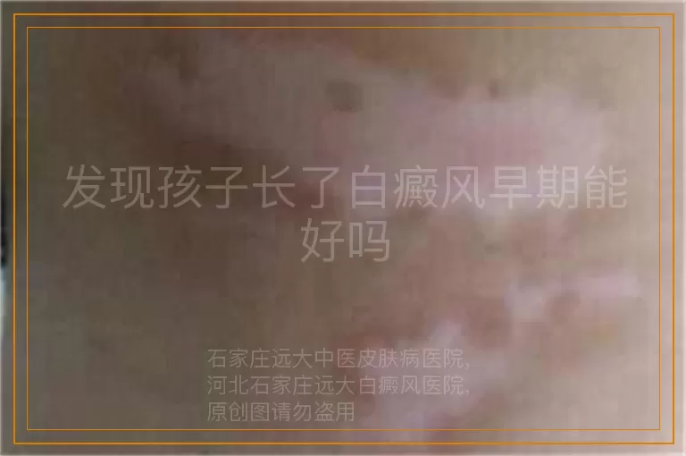 发现孩子长了白癜风早期能好吗