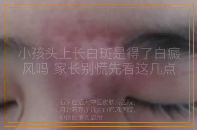 小孩头上长白斑是得了白癜风吗 家长别慌先看这几点
