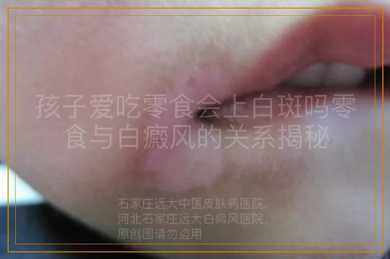 孩子爱吃零食会上白斑吗零食与白癜风的关系揭秘