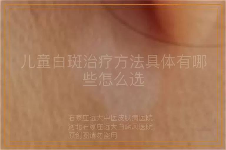 儿童白斑治疗方法具体有哪些怎么选