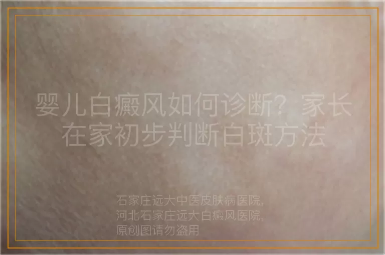 婴儿白癜风如何诊断？家长在家初步判断白斑方法