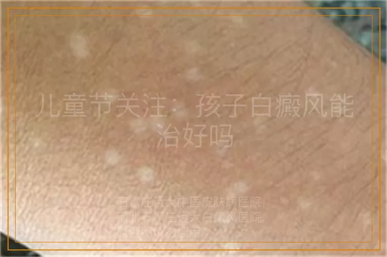 儿童节关注：孩子白癜风能治好吗