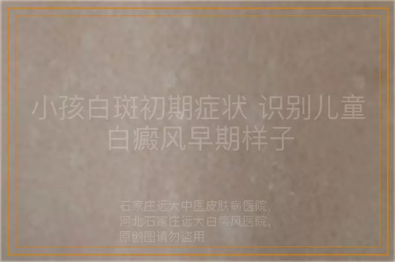 小孩白斑初期症状 识别儿童白癜风早期样子