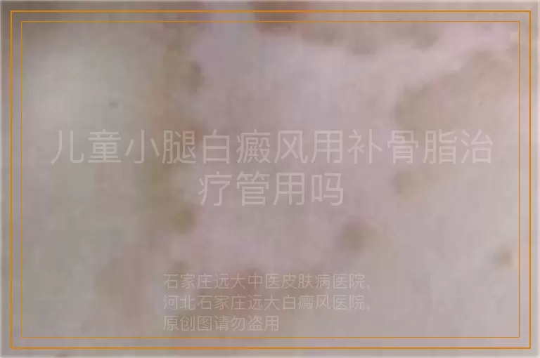 儿童小腿白癜风用补骨脂治疗管用吗