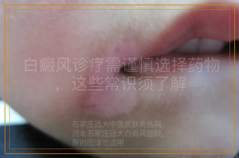白癜风诊疗需谨慎选择药物，这些常识须了解