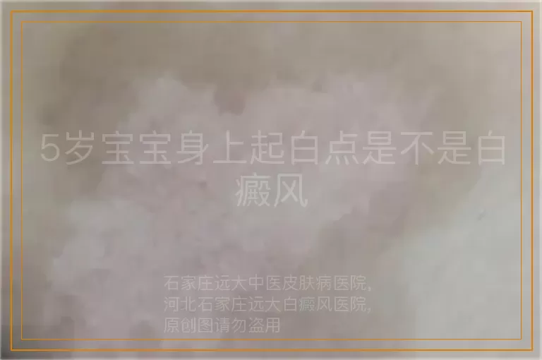 5岁宝宝身上起白点是不是白癜风