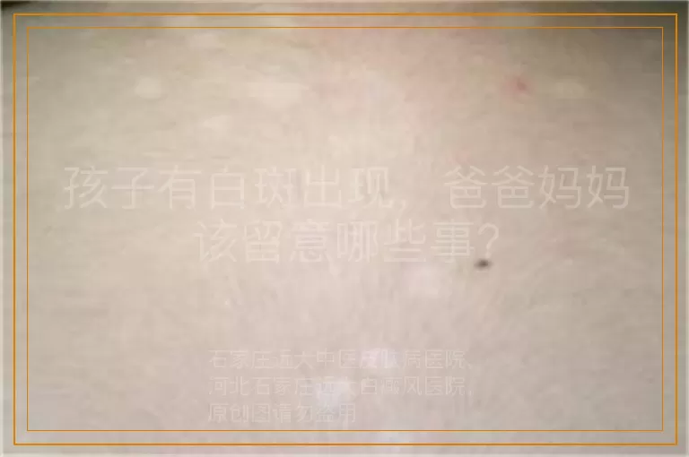孩子有白斑出现，爸爸妈妈该留意哪些事？