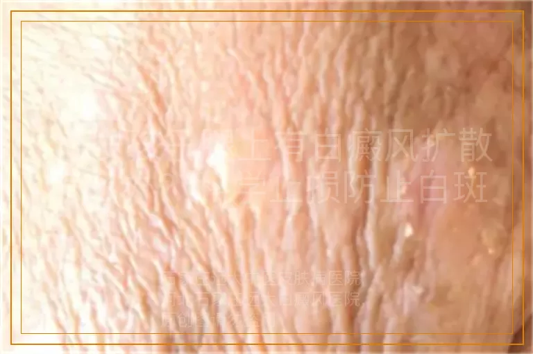 11岁孩子腿上有白癜风扩散怎么办？科学止损防止白斑扩大
