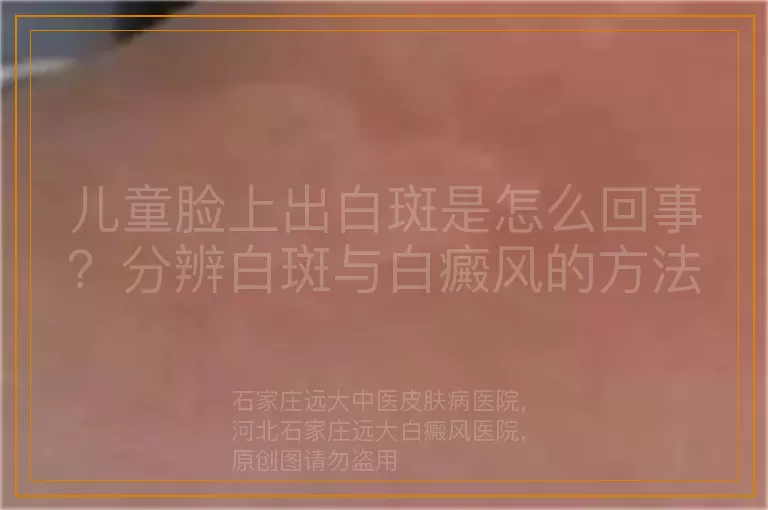 儿童脸上出白斑是怎么回事？分辨白斑与白癜风的方法