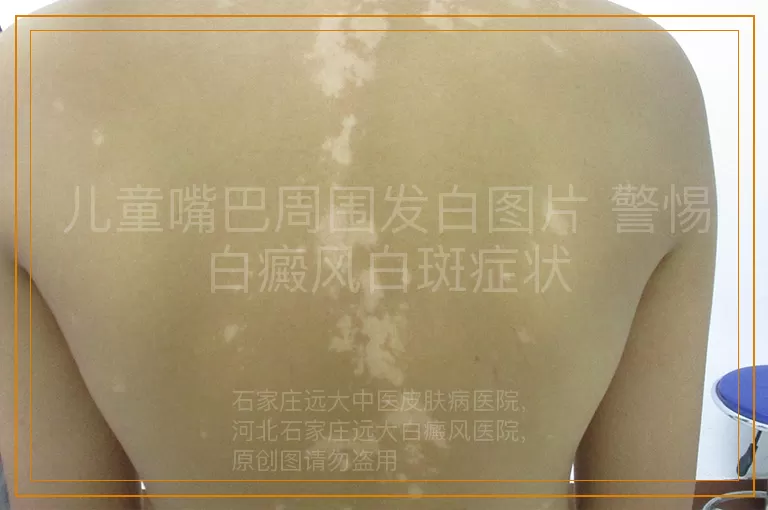儿童嘴巴周围发白图片 警惕白癜风白斑症状