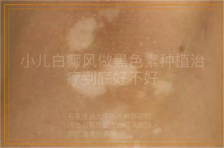 小儿白癜风做黑色素种植治疗到底好不好