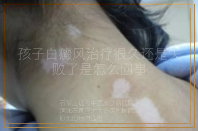 孩子白癜风治疗很久还是失败了是怎么回事