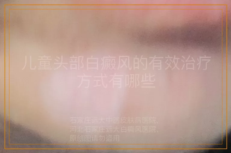儿童头部白癜风的有效治疗方式有哪些