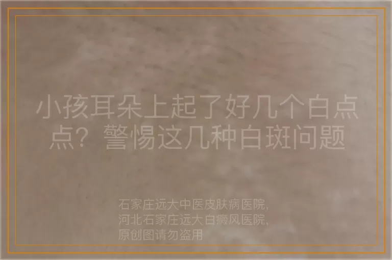 小孩耳朵上起了好几个白点点？警惕这几种白斑问题