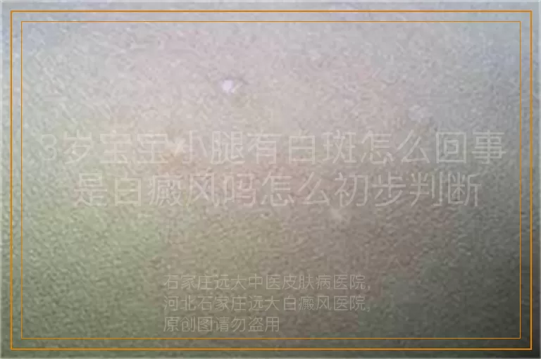 3岁宝宝小腿有白斑怎么回事 是白癜风吗怎么初步判断