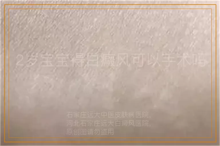 2岁宝宝得白癜风可以手术吗