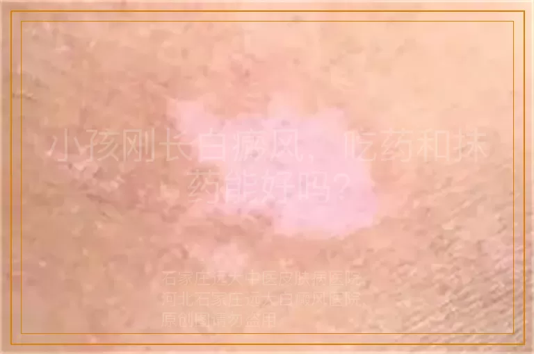 小孩刚长白癜风，吃药和抹药能好吗？