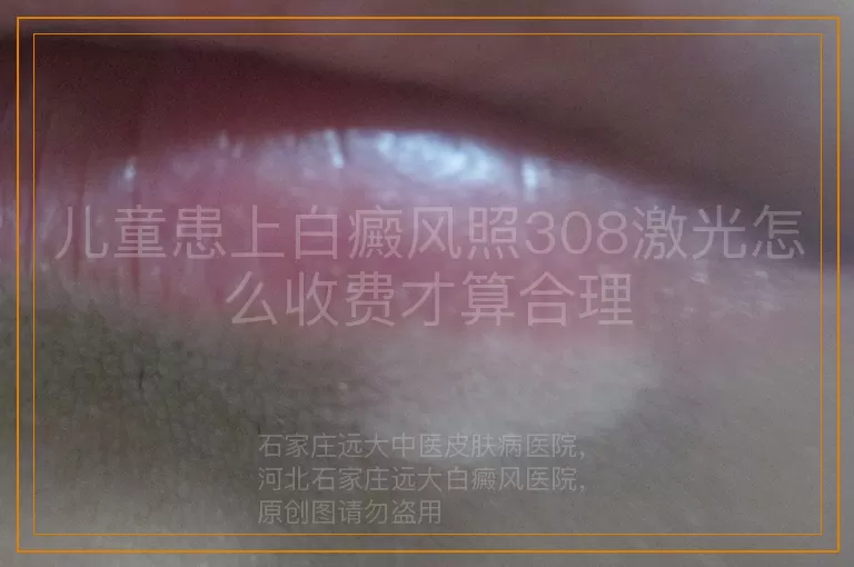 儿童患上白癜风照308激光怎么收费才算合理