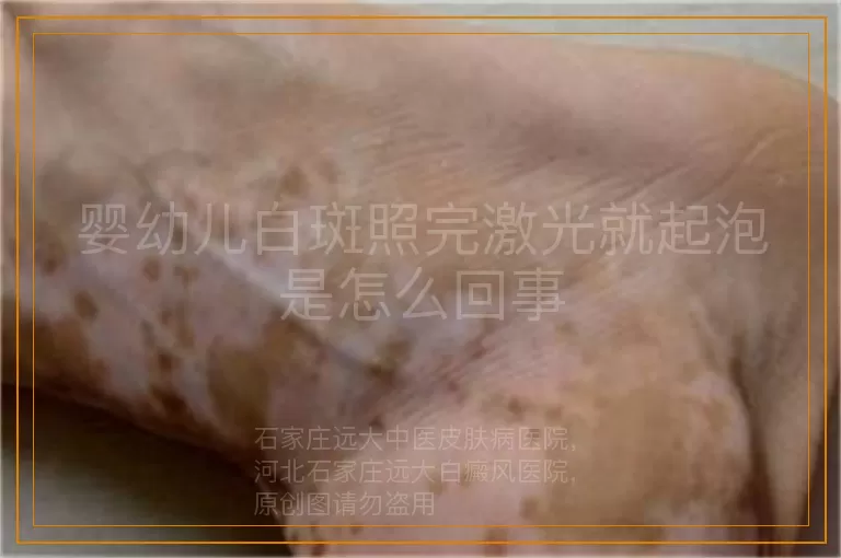 婴幼儿白斑照完激光就起泡是怎么回事