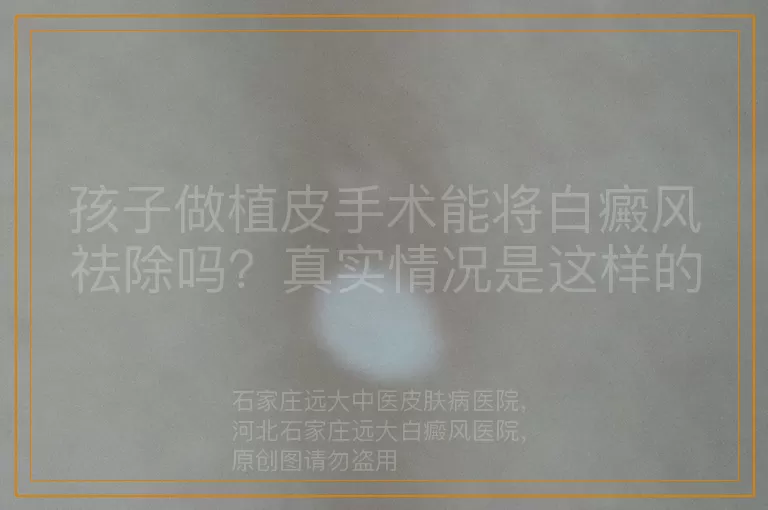 孩子做植皮手术能将白癜风祛除吗？真实情况是这样的