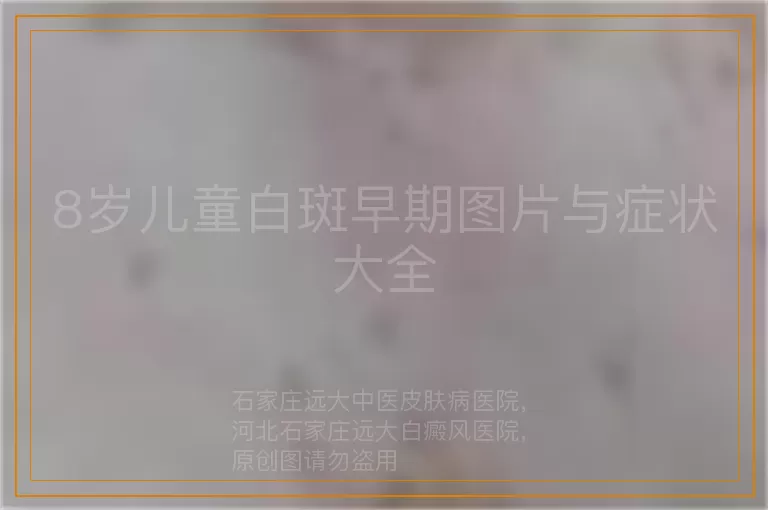 8岁儿童白斑早期图片与症状大全