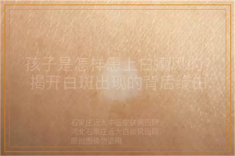 孩子是怎样患上白癜风的？揭开白斑出现的背后缘由