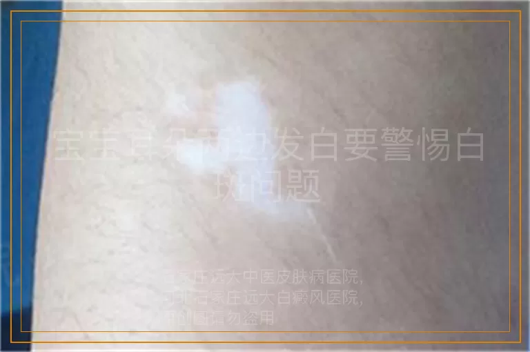 宝宝耳朵两边发白要警惕白斑问题