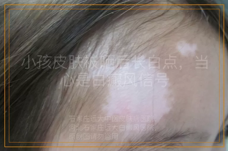 小孩皮肤被晒后长白点，当心是白癜风信号