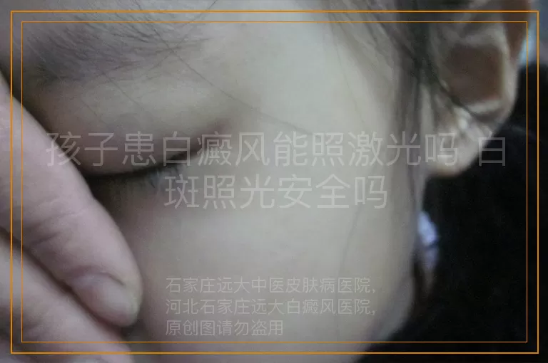 孩子患白癜风能照激光吗 白斑照光安全吗
