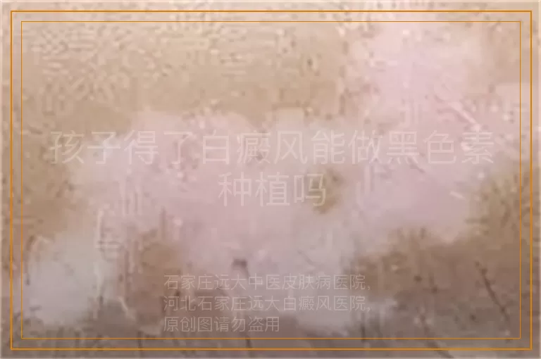 孩子得了白癜风能做黑色素种植吗