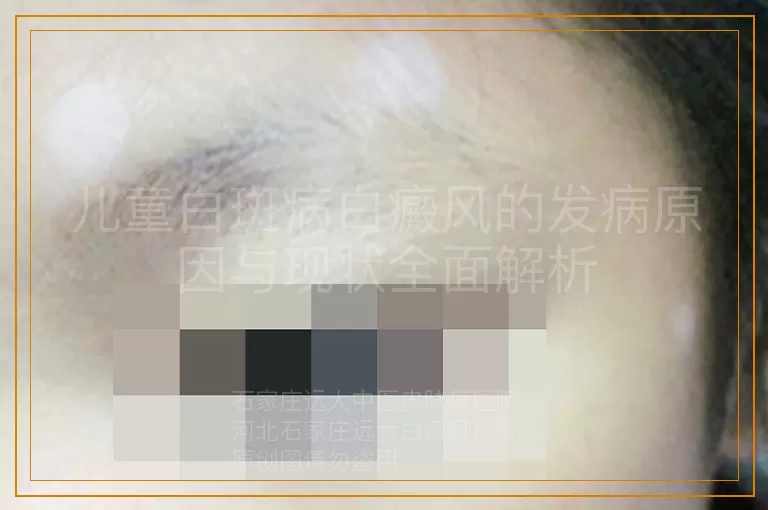 儿童白斑病白癜风的发病原因与现状全面解析