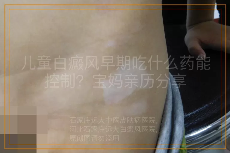 儿童白癜风早期吃什么药能控制？宝妈亲历分享