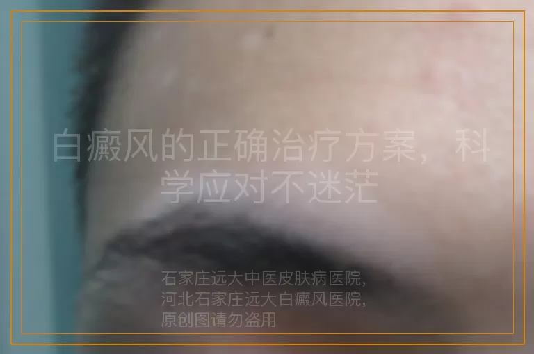 白癜风的正确治疗方案，科学应对不迷茫