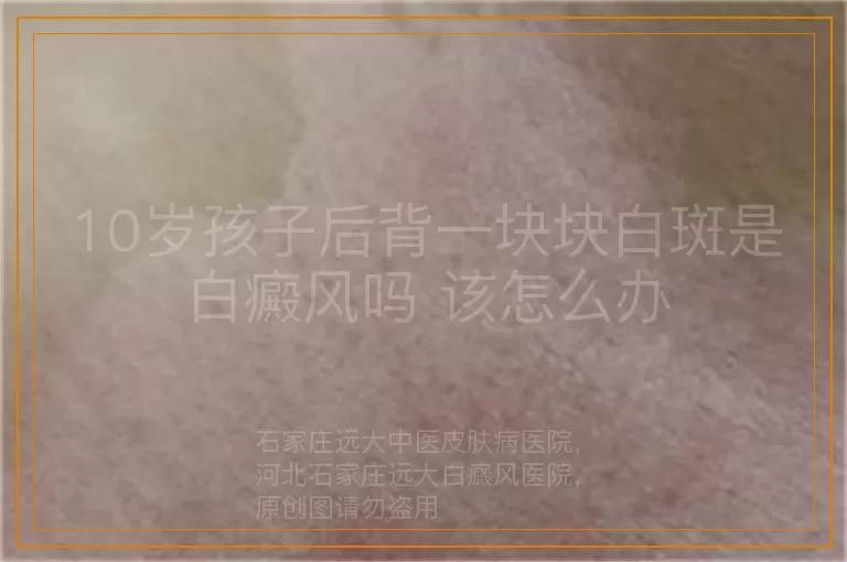 10岁孩子后背一块块白斑是白癜风吗 该怎么办